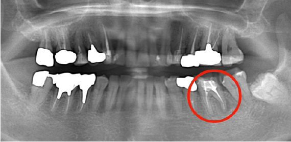 Case01　治療前のレントゲン1