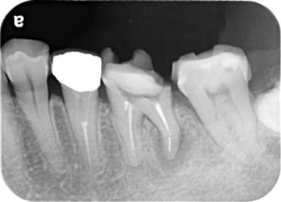 Case01　治療前のレントゲン2