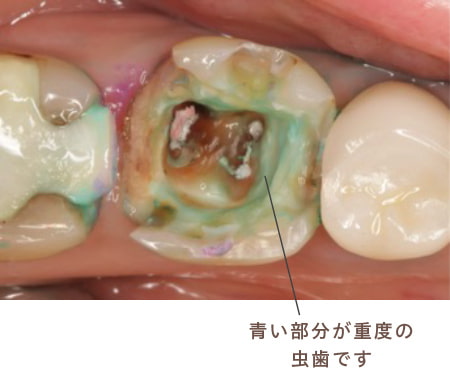 青い部分が重度の虫歯です