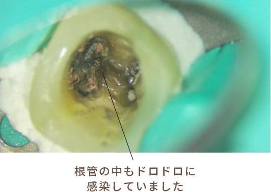根管の中もドロドロに感染していました