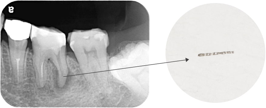 Case01　折れて残っていた機具の写真