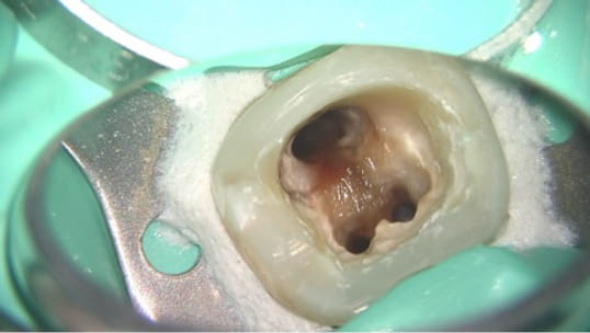 Case01　根管の中を洗浄した写真