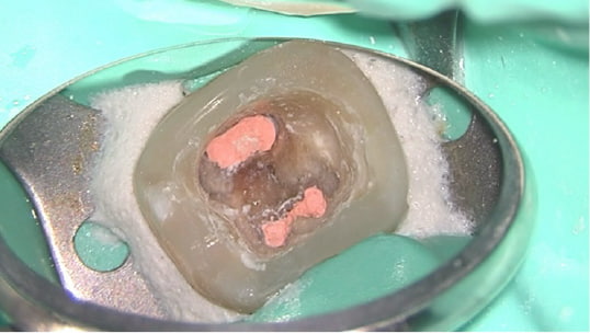 Case01　根管の中を封鎖した写真