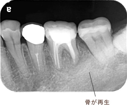 骨が再生