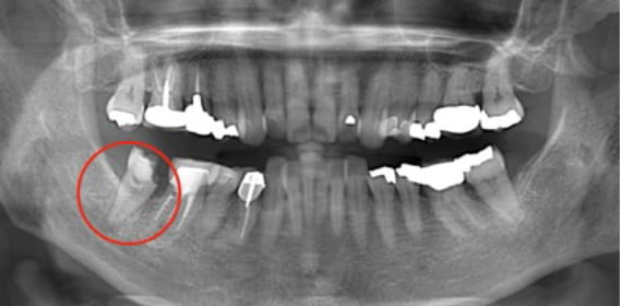 Case02　治療前のレントゲン1