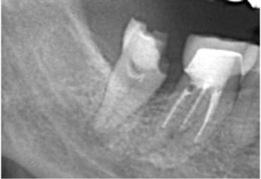 Case02　治療前のレントゲン2