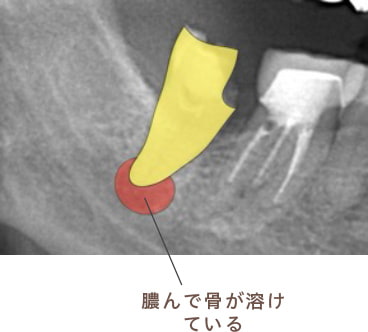 膿んで骨が溶けている