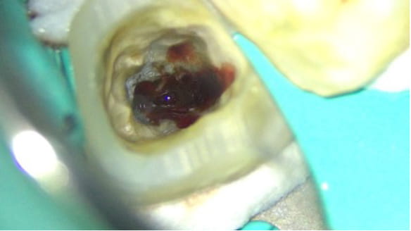 Case02　膿が出ている写真