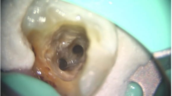 Case02　根管の中を洗浄した写真