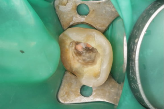 Case02　根管の中を封鎖した写真