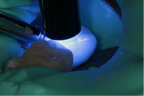 Case02　上から被せを精密に接着させた写真