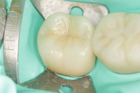 Case02　治療直後の写真