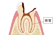 神経が虫歯に侵された