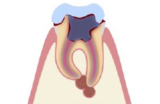 根の先が膿んでしまった