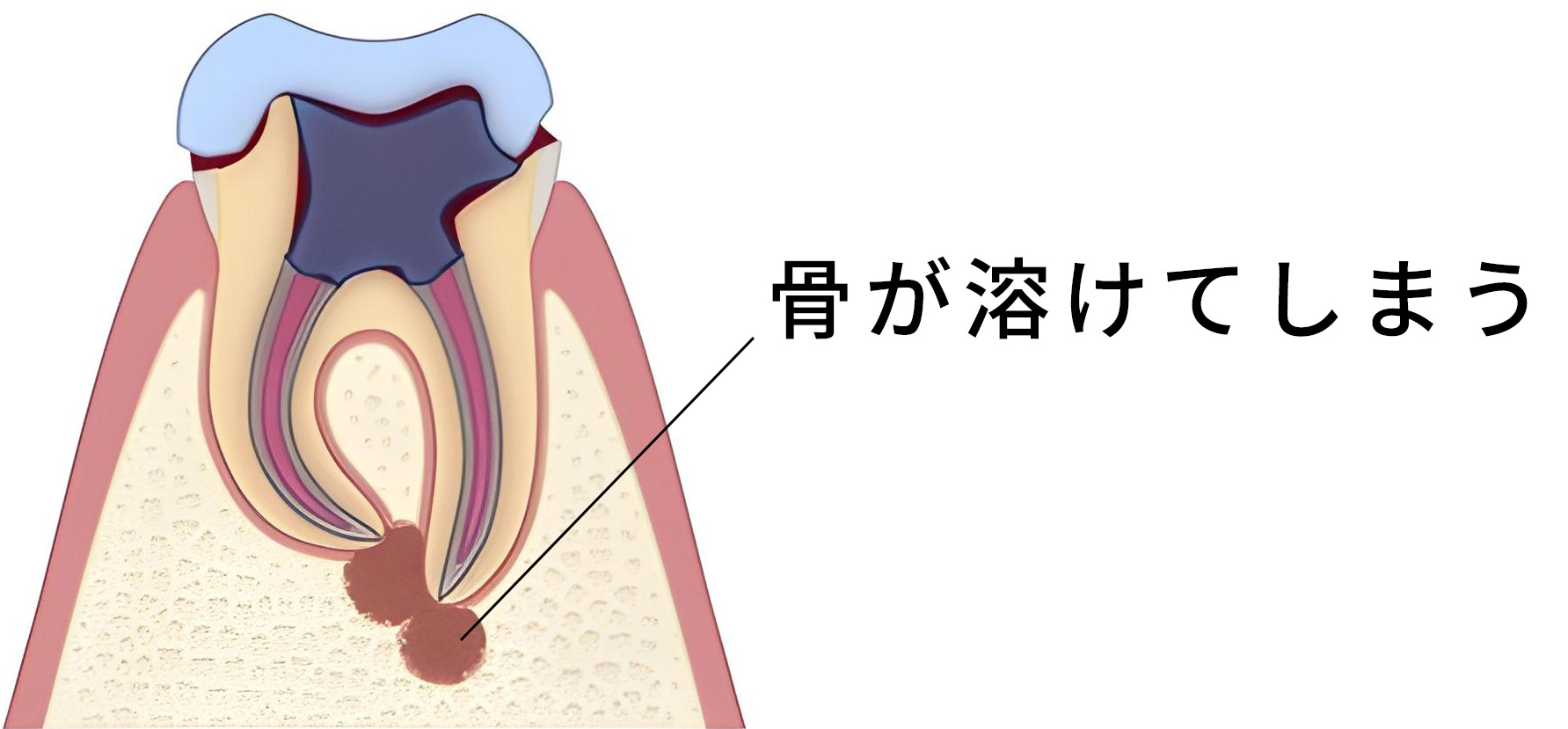 骨が溶けてしまう