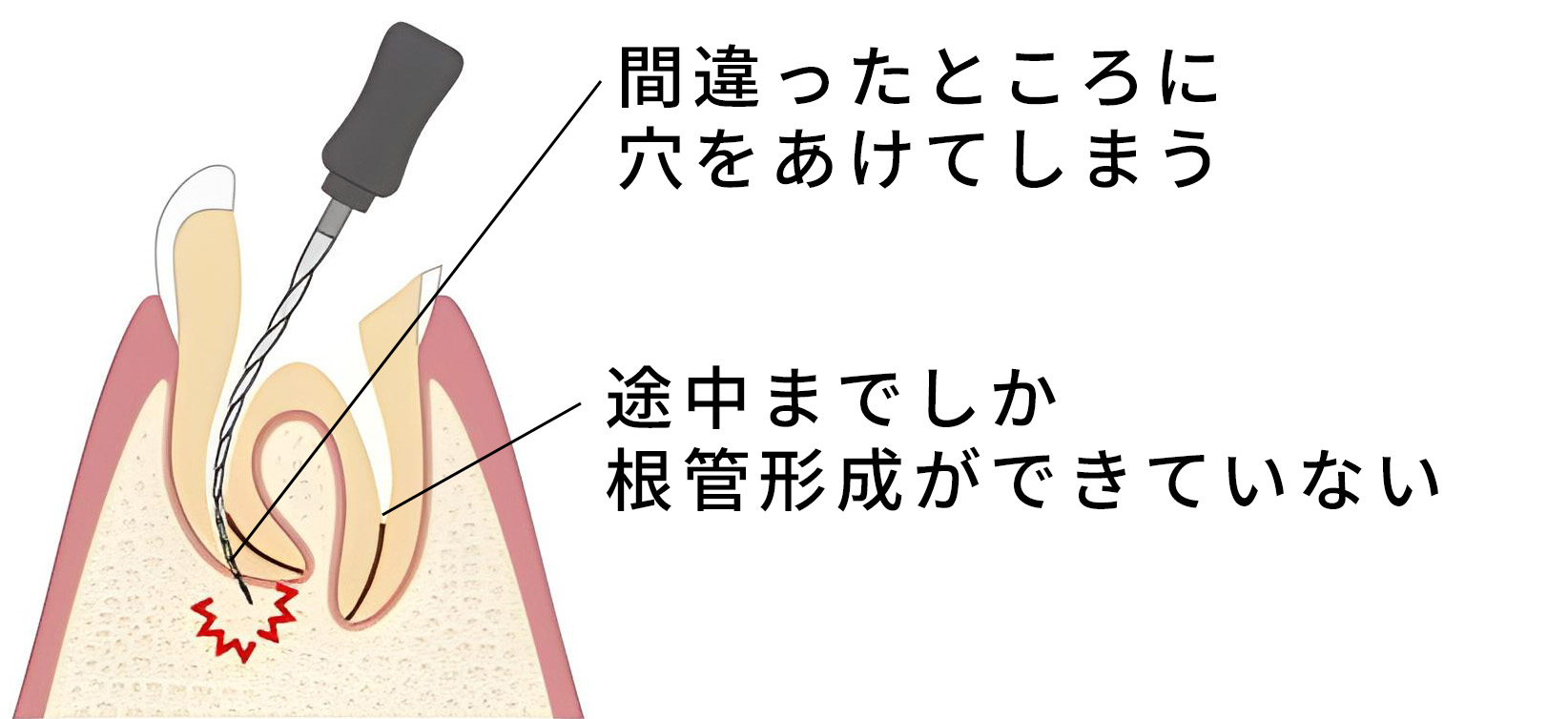 根管形成