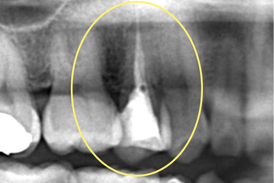 修復物除去・う蝕除去・髄腔開拡