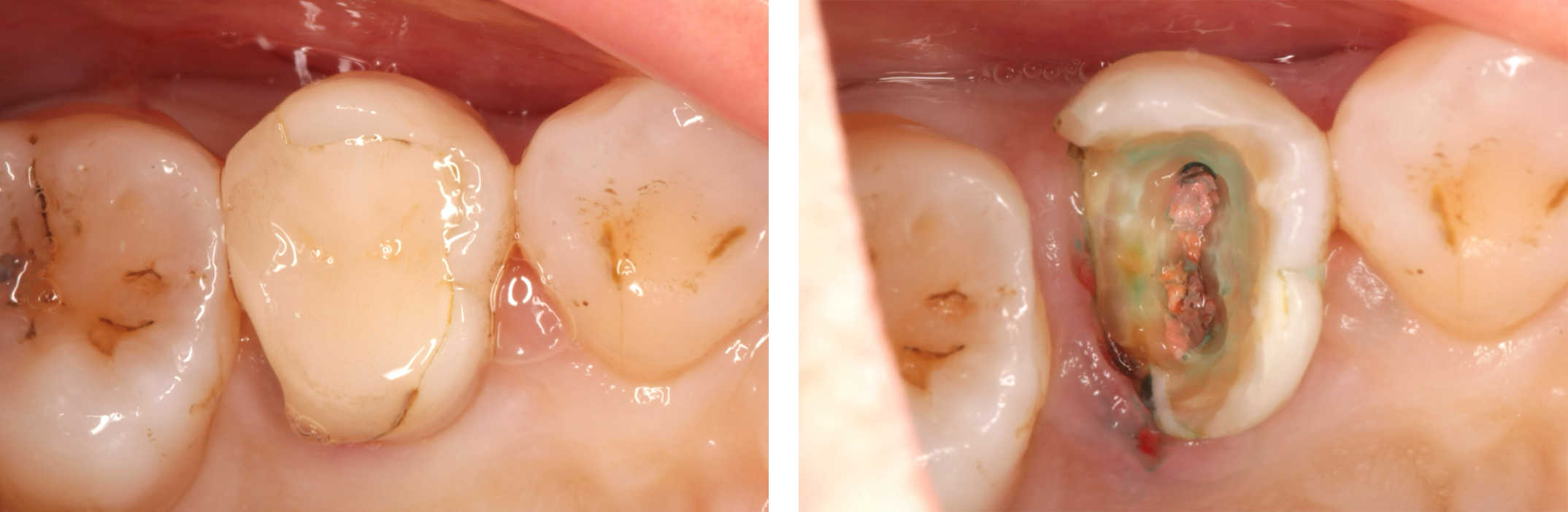 修復物除去・う蝕除去・髄腔開拡