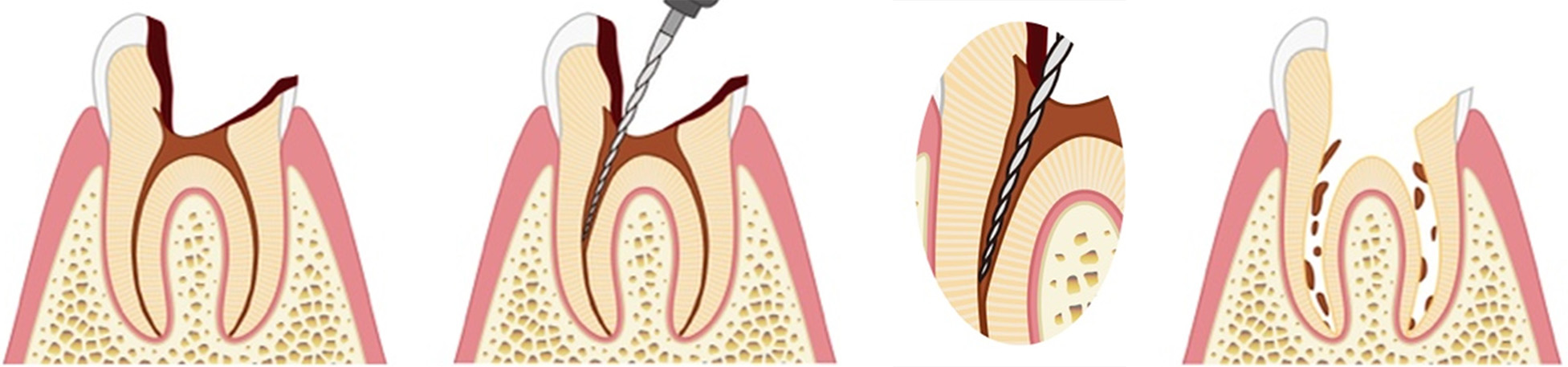 根管洗浄・根管充填を行いやすいように根管の形を整える